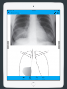 CXR FlashCards - Reference app for Chest X-rays screenshot 6