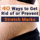 40 Ways to Get Rid of or Prevent Stretch Marks Icon