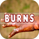 Burns: Causes, Diagnosis, and Management