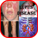 Lupus: Causes, Diagnosis, and Treatment