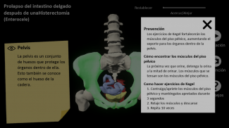 myProlapse: Anatomy of Post-Hysterectomy Prolapse screenshot 8