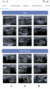Thyroid Nodules - Ultrasound Guide screenshot 6