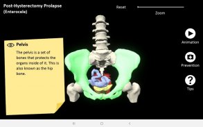 myProlapse: Anatomy of Post-Hysterectomy Prolapse screenshot 14