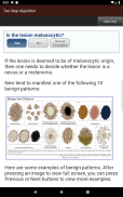 Dermoscopy Two Step Algorithm screenshot 12