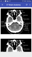 CT Brain Interpretation screenshot 1