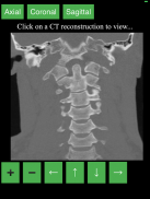 CT Cervical Spine screenshot 3