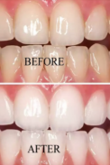 teeth whitening naturally tips screenshot 1