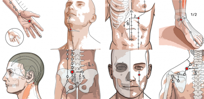 acupuncturepoint trial