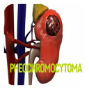 Pheochromocytoma