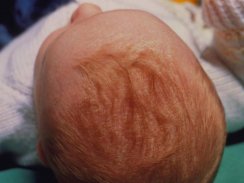 Cradle Cap in Babies Tips screenshot 1