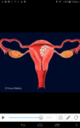 Polycystic Ovarian Syndrome screenshot 4