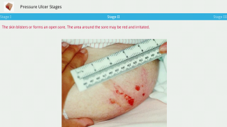 Pressure Ulcer screenshot 12