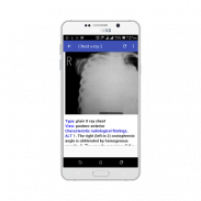 Chest X-ray Easy Learning screenshot 1