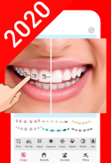 Braces Camera 2020 : Best  Braces  Editor of 2020 screenshot 0