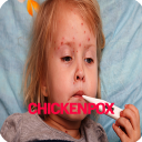 Chickenpox Disease