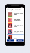 BCG Pressure Ulcer Guide screenshot 0