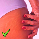 Get rid of STRETCH MARKS Naturally - Home Remedies Icon