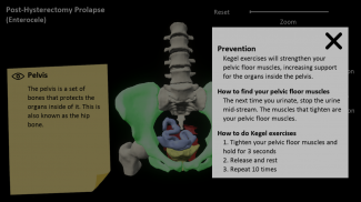 myProlapse: Anatomy of Post-Hysterectomy Prolapse screenshot 1