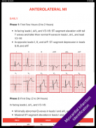 ECG FlashCards 2 Lite - Free Reference EKG App screenshot 4