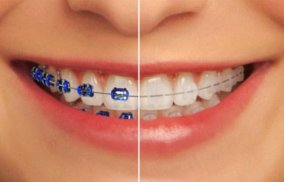 Dental Braces screenshot 2