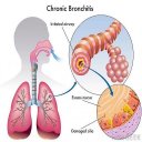 All respiratory disorder