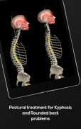 Kyphosis & Rounded Back by M&M screenshot 9