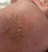 Cradle Cap in Babies Tips screenshot 0