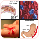 All Blood Disease and Treatment A-Z