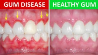 Gum Disease Remedies screenshot 1