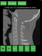 CT Cervical Spine screenshot 2