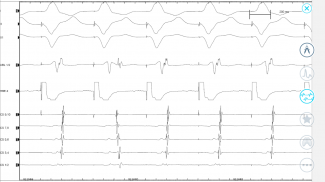 Cardiac Arrhythmia Challenge screenshot 10