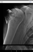 AO/OTA Fracture Classification screenshot 13