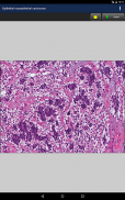 Anatomic Pathology Flashcards screenshot 9
