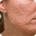 Acne Scar Removal Home Remedy Icon