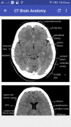 CT Brain Interpretation screenshot 2