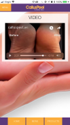 Callus Peel screenshot 4