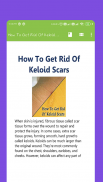 How To Get Rid Of Keloid Scars screenshot 4