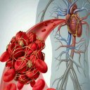 Blood Clot Home & Natural Remedies