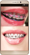 Braces Photo Editor - Braces For Your Teeth screenshot 1