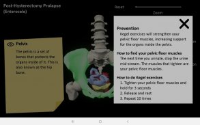 myProlapse: Anatomy of Post-Hysterectomy Prolapse screenshot 9